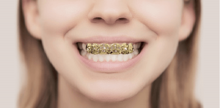 Can You Wear Grillz over Braces?