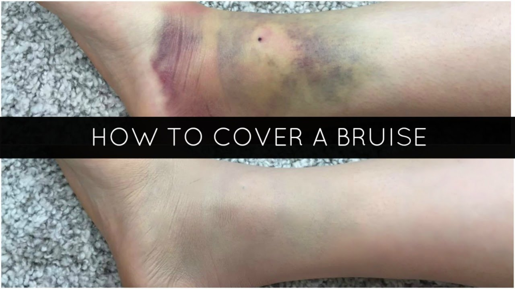 How to Cover a Bruise Effectively?