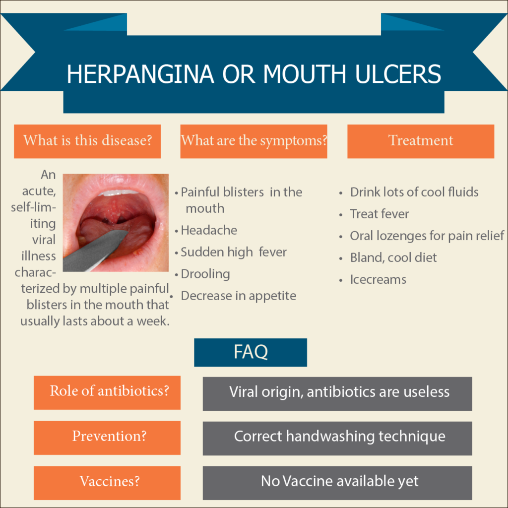 Is Herpangina Contagious Without a Fever?